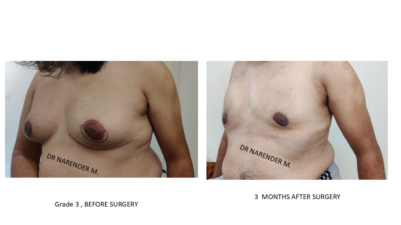 Gynecomastia Photo 6